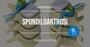 Spondiloartrosi
