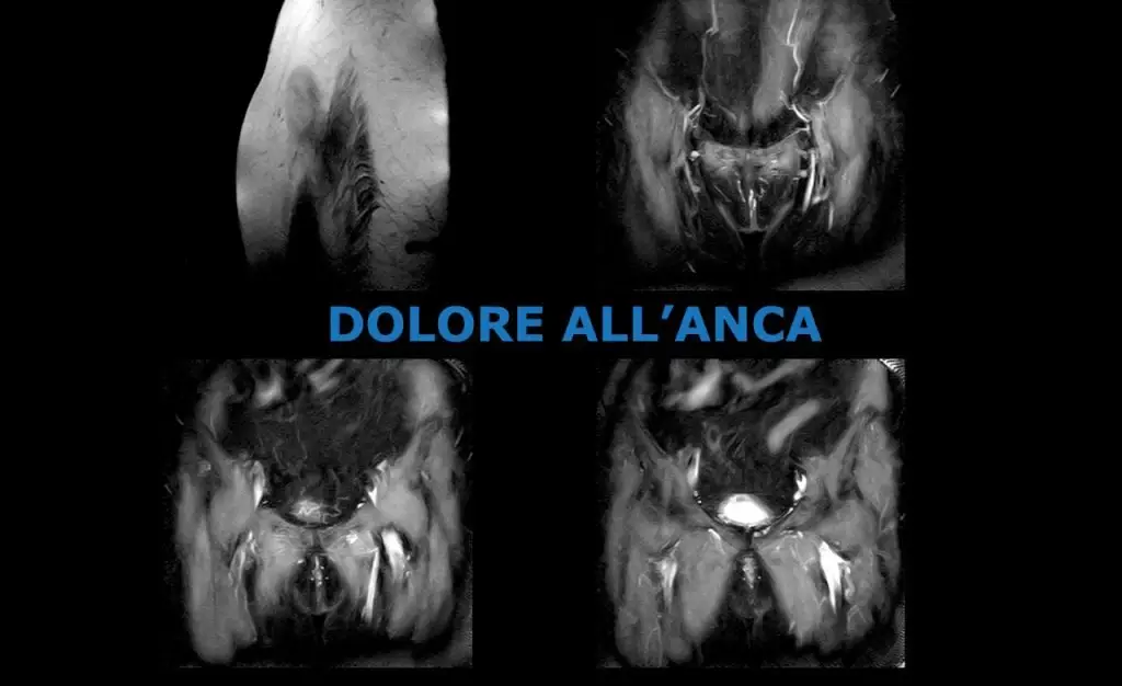 Dolore all'anca: che esami fare? 2 Dolore all'anca