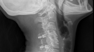 Laminoplastica cervicale