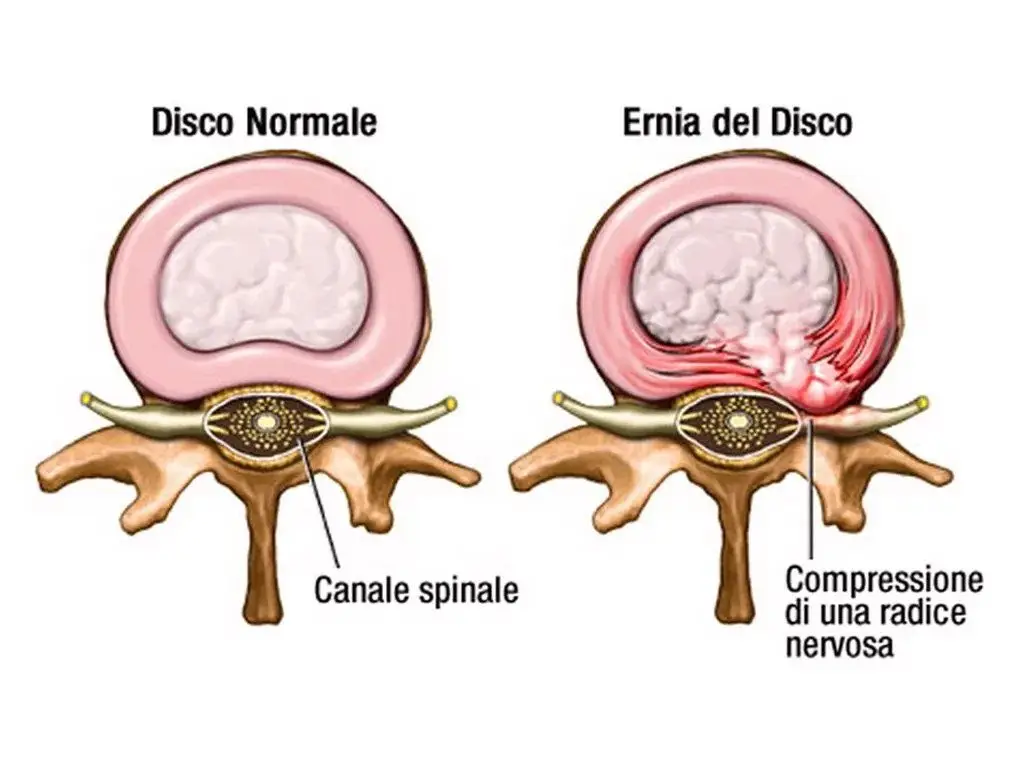 Schema dell’ernia del disco e compressione del nervo